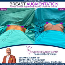 Breast Augmentation Before After
Breast Implants Turkey Antalya
