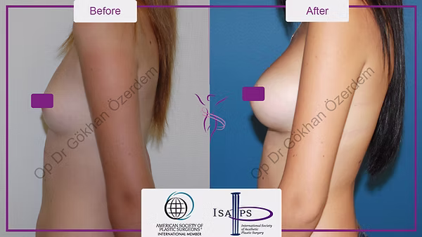 BREAST AUGMENTATION BREAST IMPLANT SURGERY ANTALYA TURKEY BEFORE AFTER