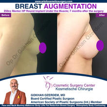 Breast Augmentation Before After
Breast Implants Turkey Antalya