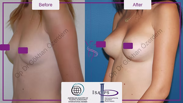 BREAST AUGMENTATION BREAST IMPLANT SURGERY ANTALYA TURKEY BEFORE AFTER