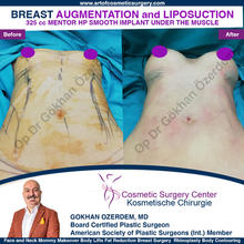 Breast Augmentation Before After
Breast Implants Turkey Antalya