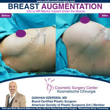 BREAST AUGMENTATION BREAST IMPLANT SURGERY ANTALYA TURKEY