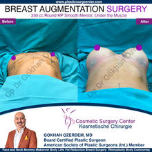 Breast Augmentation Before After
Breast Implants Turkey Antalya