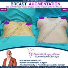 Breast Augmentation Before After
Breast Implants Turkey Antalya