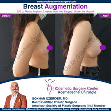 Breast Augmentation Before After
Breast Implants Turkey Antalya