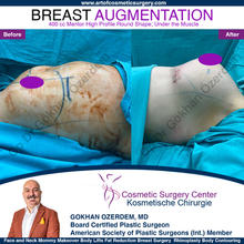 Breast Augmentation Before After
Breast Implants Turkey Antalya