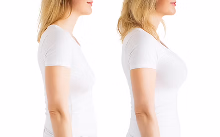 Woman before and after breast augmentati