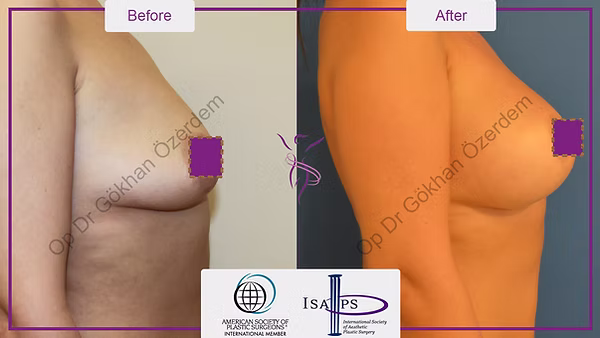 BREAST AUGMENTATION BREAST IMPLANT SURGERY ANTALYA TURKEY BEFORE AFTER