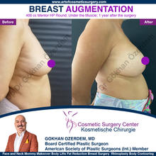 Breast Augmentation Before After
Breast Implants Turkey Antalya