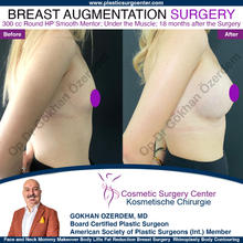 Breast Augmentation Before After
Breast Implants Turkey Antalya