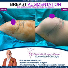 Breast Augmentation Before After
Breast Implants Turkey Antalya