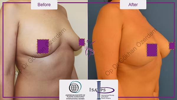 BREAST AUGMENTATION BREAST IMPLANT SURGERY ANTALYA TURKEY BEFORE AFTER